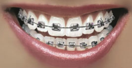 Braces