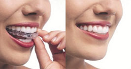 Invisalign